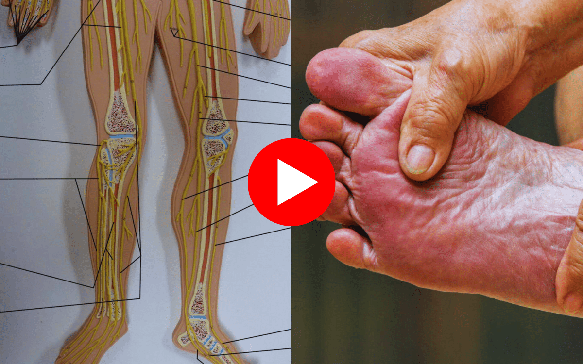Clear This “Nerve Plaque” Clogging Your Nerves to Eliminate Neuropathy