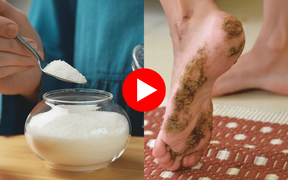 Neuropathy? Use Sugar (Like This One) To Fix Years Of Nerve Pain