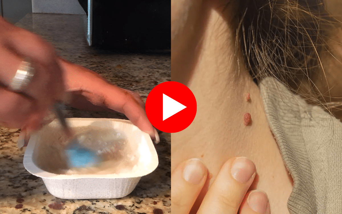 This Oatmeal Hack Makes Skin Tags Vanish Almost Overnight